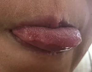 Наросты на бахромчатых складках языка