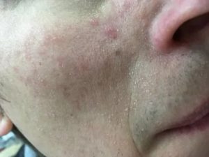 Зудящие высыпания на лице
