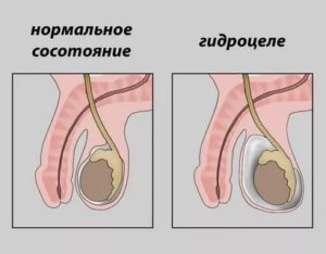 Сдавили одеждой яички ребенку