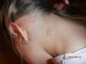 Пятно на ухе у ребёнка