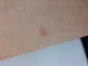 Пятна на теле которые меняют цвет и не передаются