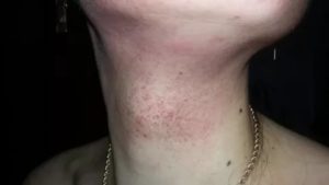 Мелкая сыпь по всему лицу и шее