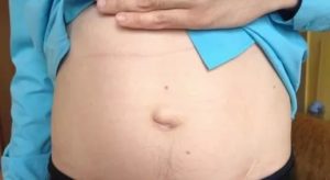 Слева от пупка ноющее уплотнение