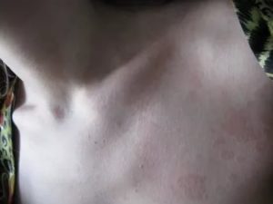 Светло-коричневые пятна на коже шеи