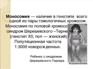 Моносомия хромосомы Х