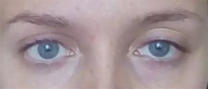 Одно веко ниже другого
