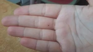 Опасная от родинка на мизинце ноги