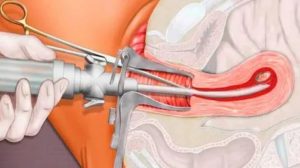 Резкие боли внизу живота после вакуумной аспирации