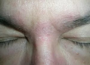 Шелушение кожи на лбу и лице