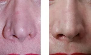 Можно ли иссечь атрофический рубец на носу?