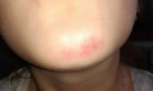 Пятно на подбородке