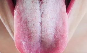 Белый налет на языке, диарея, кариес