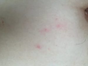 Появились симметричные прыщи по телу