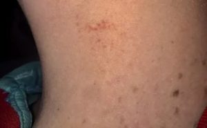 Пятна на теле похожи на засос
