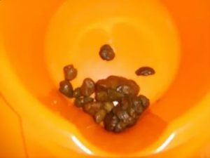 Ребенок какает шариками, как камyшки