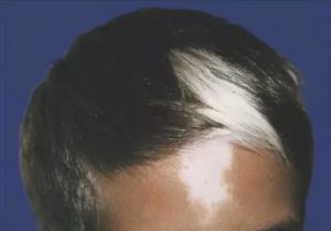 Белый клок волос на голове