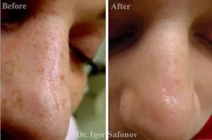 Можно ли иссечь атрофический рубец на носу?