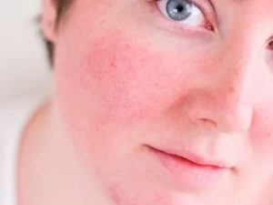 Розацеа-розовые угри