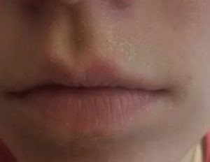 Шелушение над верхней губой с одной стороны белыми хлопьями