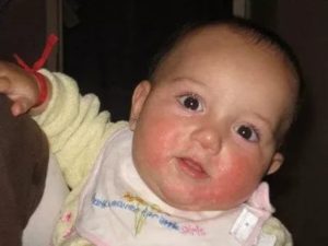 Может ли быть аллергия на супрастин?