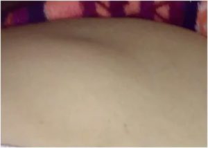 Шишка на животе