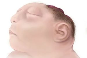 Акрания плода