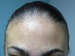 Мелкие прыщи на коже подростка