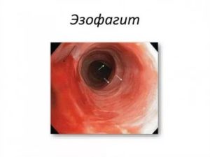 Рефлюкс эзофагит 1степени, поверхностный гастрит и деуденит