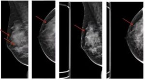 Фиброзно кистозная мастопатия, болезнь Минца