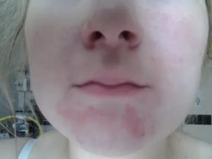 Пятно на подбородке