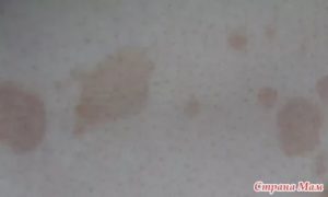 Пятна на теле которые меняют цвет и не передаются