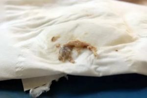 Срок беременности 7-8 недель. Начались кровянистые выделения