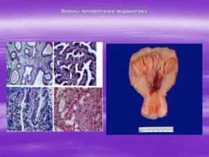 Прогрессирующая гиперплазия эндометрия