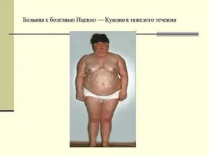 Синдром Иценко Кушинга