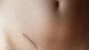 Разрастается шрам после аппендицита