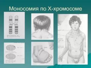 Моносомия хромосомы Х