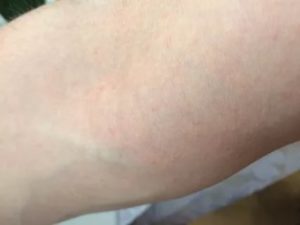 Прыщи на бицепсе переходят на руки ниже