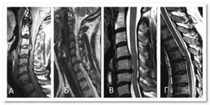 Боль при протрузии реберной дуги