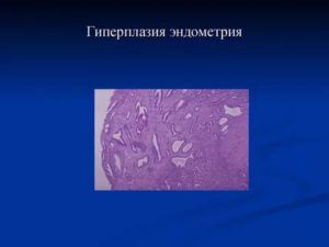 Прогрессирующая гиперплазия эндометрия