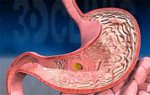 Тяжесть в желудке и синдром манной крупы