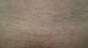 Зуд и шелушение на лобке и голене