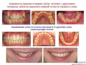 Удалили клык