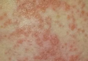 Изопринозин высыпания на коже