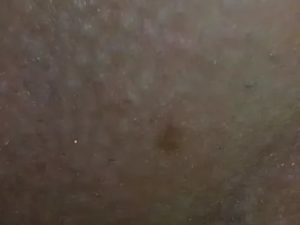 Пигментация на половой губе