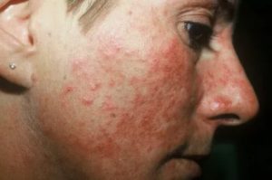 Розоцеа после отмены Акридерма