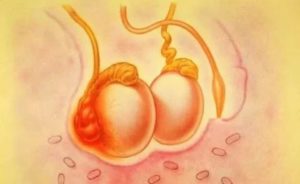 Шишка под яичком