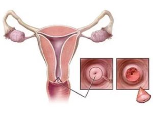 Секс после конизациии шейки матки