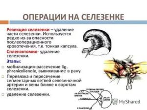 Спленэктомия и новая селезёнка