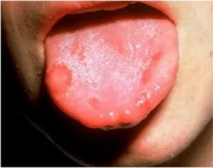 Увеличивающияся язвочка