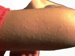 Прыщи на бицепсе переходят на руки ниже